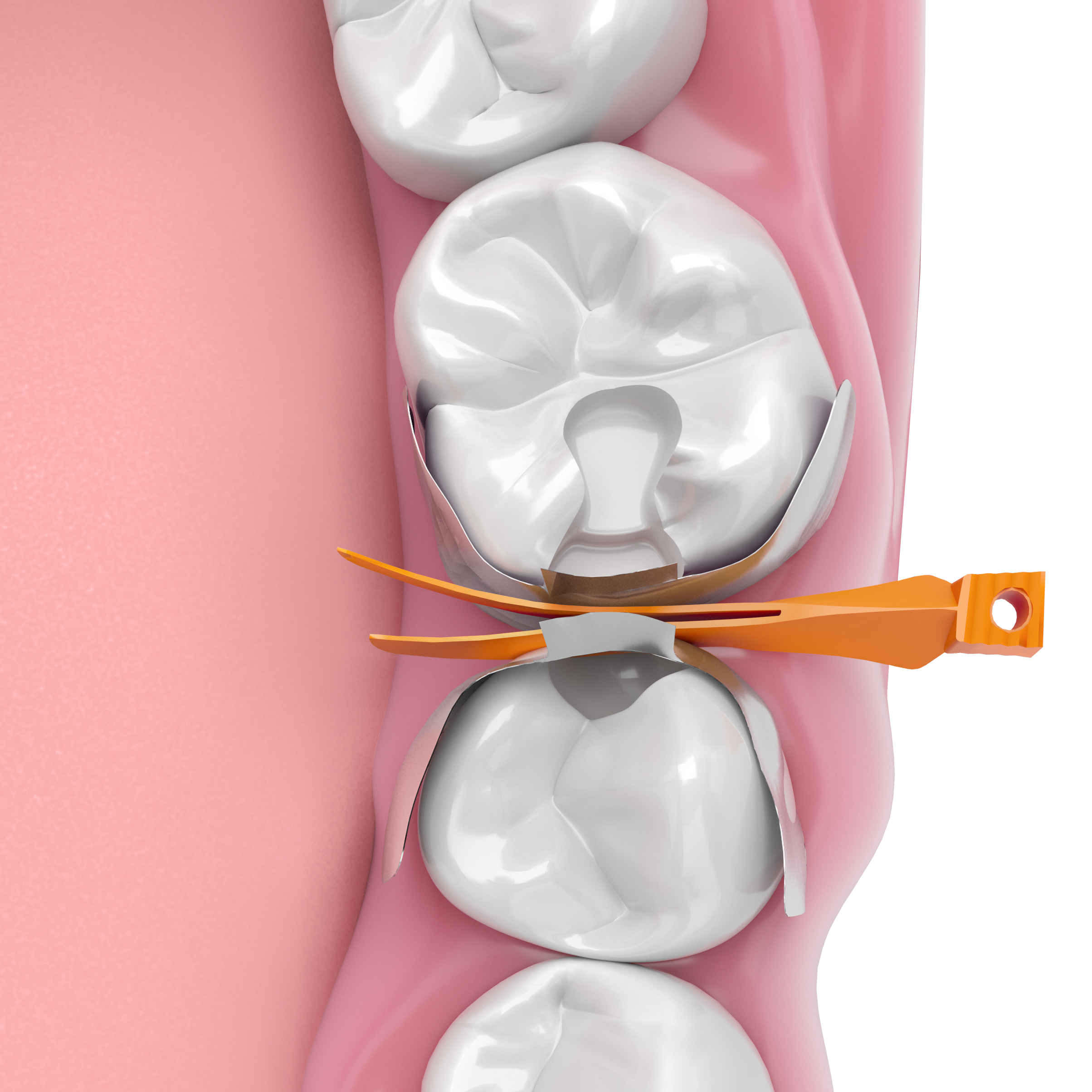 Quad Medium Orange Wedge Refill: 100 (QOR)